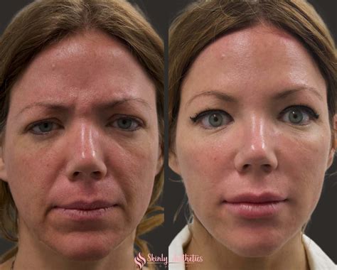 queensland juvederm|16 Juvederm doctors & clinics in Brisbane, Australia .
